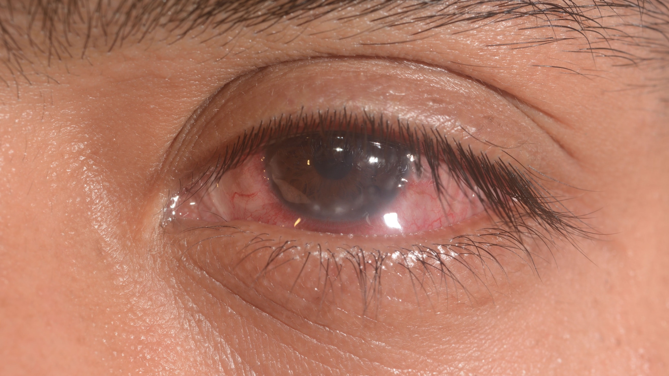 Keratoconjunctivitis close up of eye Keratoconjunctivitis close up of eye