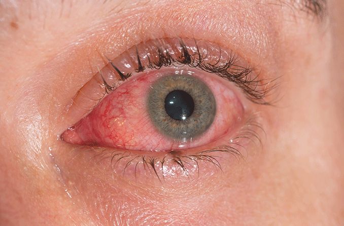 What is pink eye (conjunctivitis)?