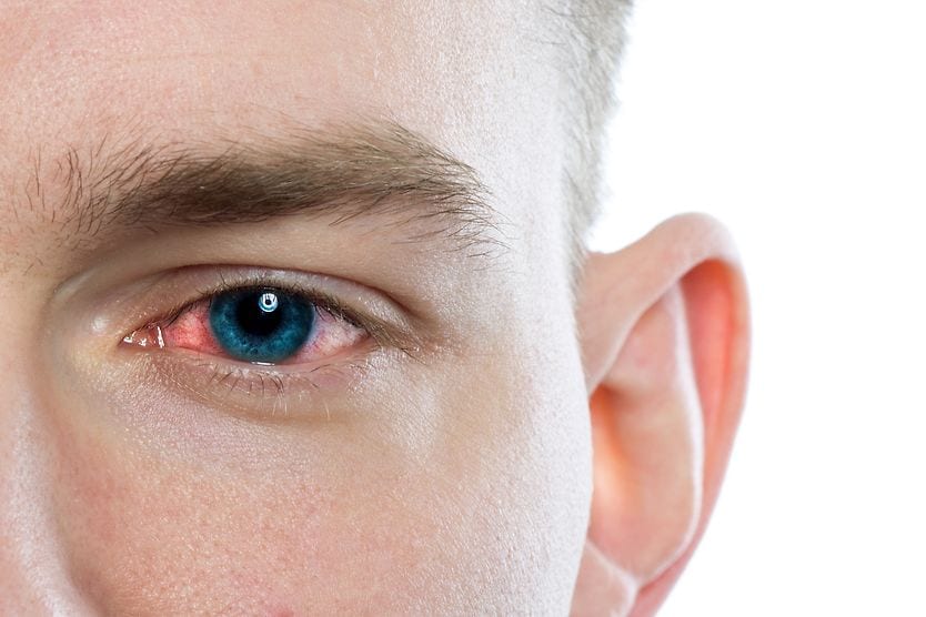 Close-up of person's red eye. Conjunctivitis or irritation of sensitive eyes.