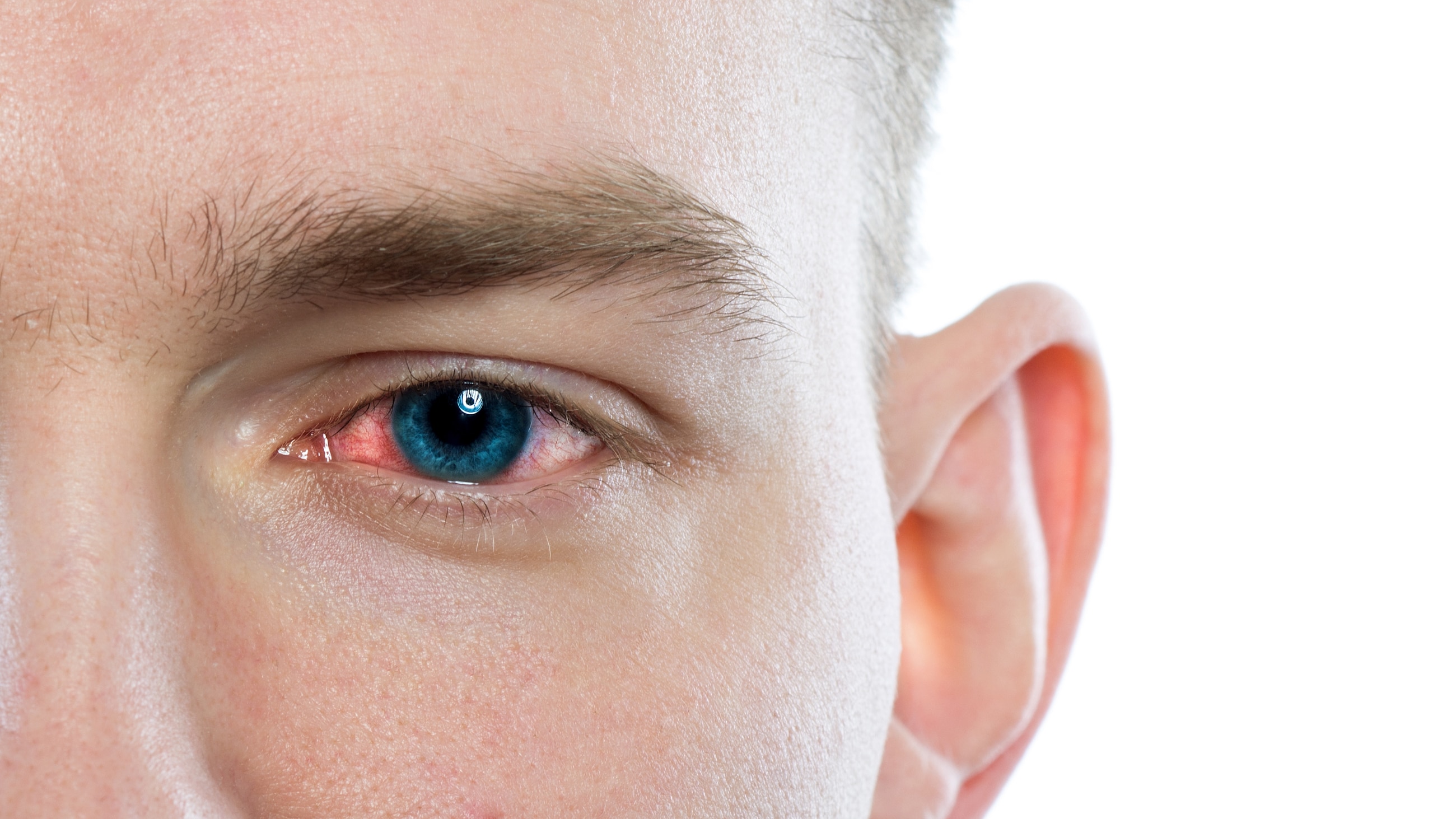 Types of pink eye: Bacterial, viral and allergic conjunctivitis Types of pink eye: Bacterial, viral and allergic conjunctivitis