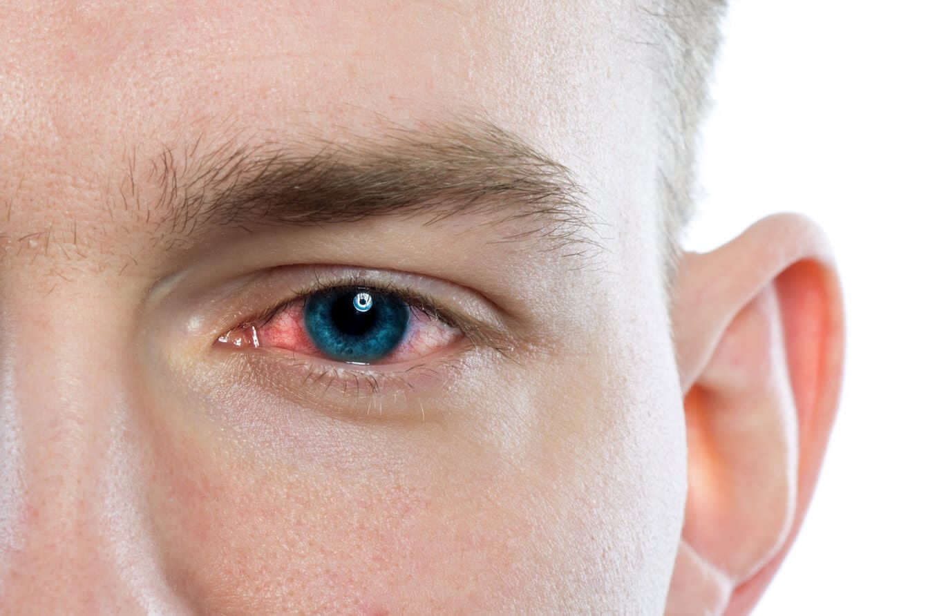 Types of pink eye: Bacterial, viral and allergic conjunctivitis