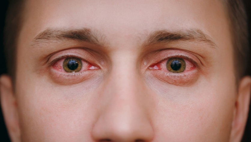 How long is pink eye contagious?