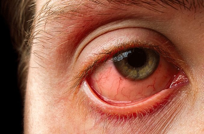 closeup of a man's eye showing conjunctivitis (pink eye) symptoms of a red and swollen eye