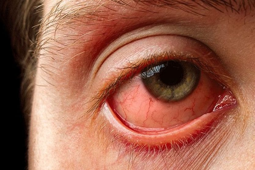 closeup of a man's eye showing conjunctivitis (pink eye) symptoms of a red and swollen eye closeup of a man's eye showing conjunctivitis (pink eye) symptoms of a red and swollen eye