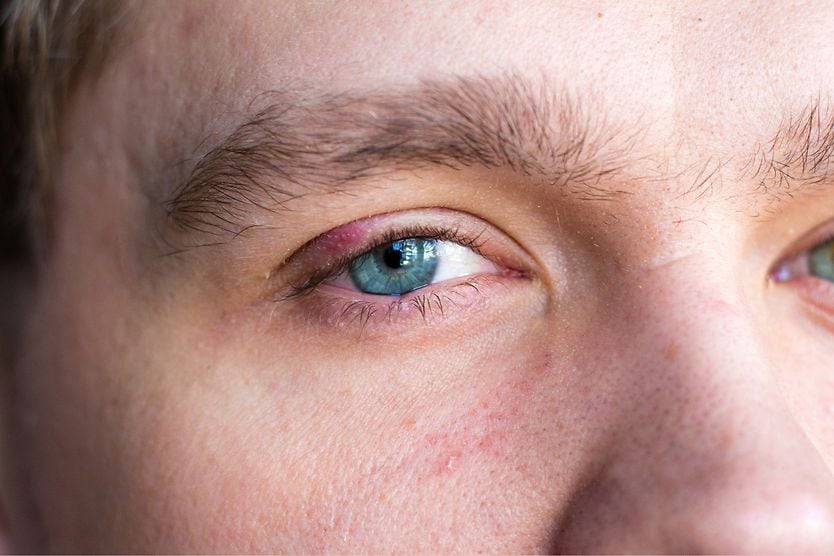 man with a stye man with a stye
