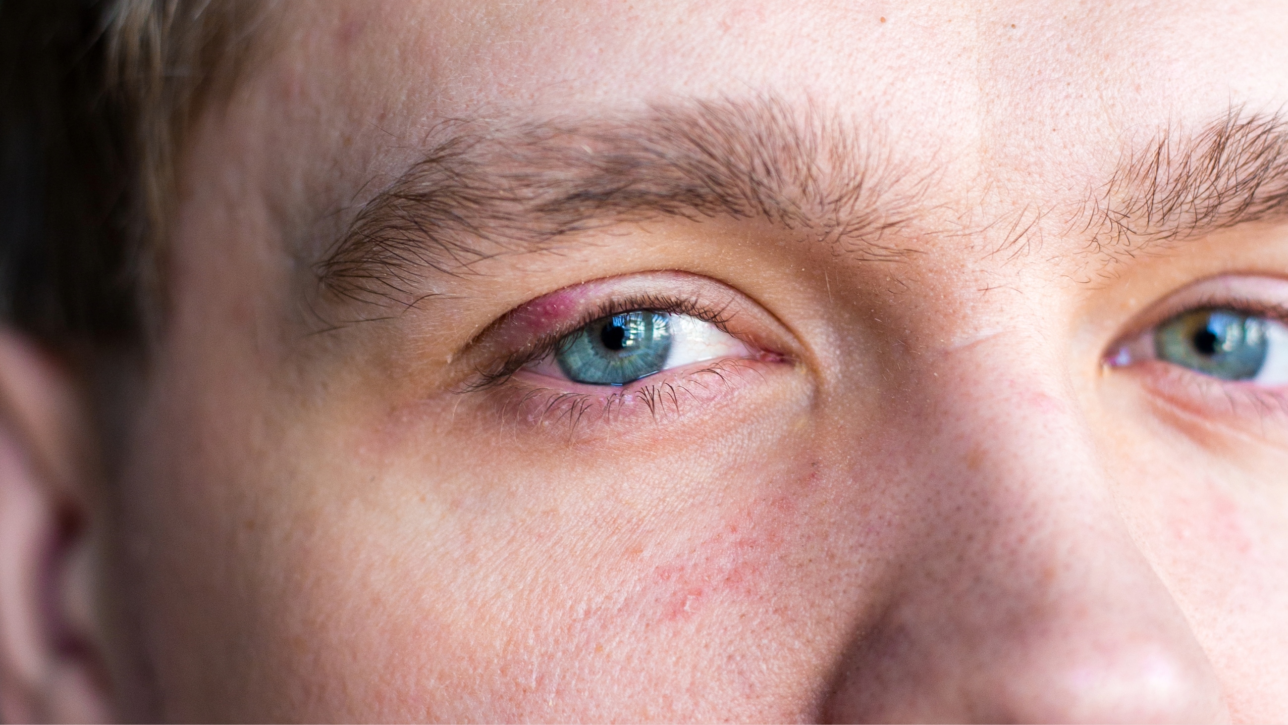 How do you get a stye? How do you get a stye?