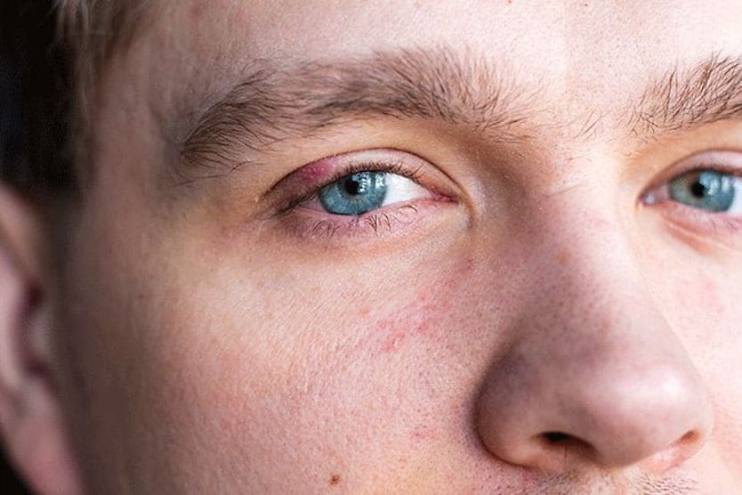 man with a stye man with a stye