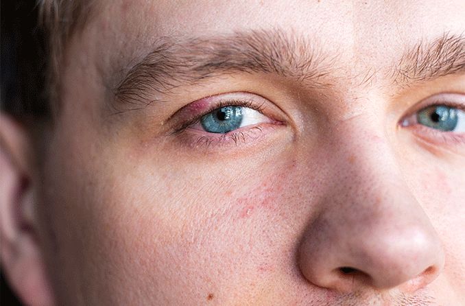 How do you get a stye?