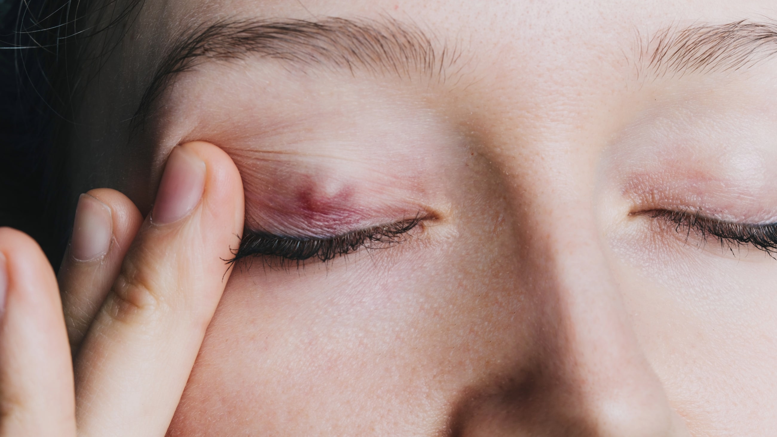Chalazion: Symptoms, causes, treatment and prevention Chalazion: Symptoms, causes, treatment and prevention