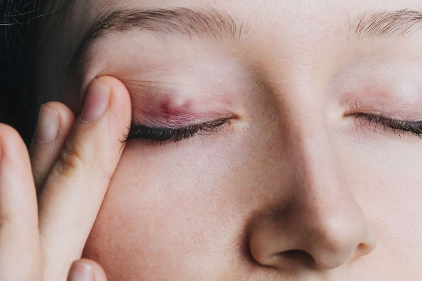 Young girl shows a chalazion on the eyelid closeup. Young girl shows a chalazion on the eyelid closeup.