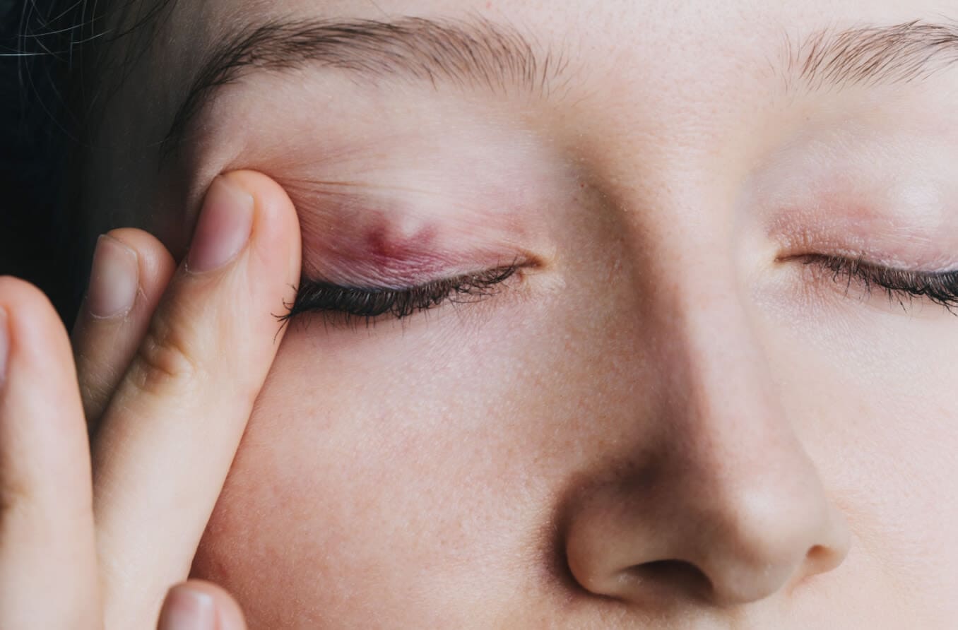 Chalazion: Symptoms, causes, treatment and prevention