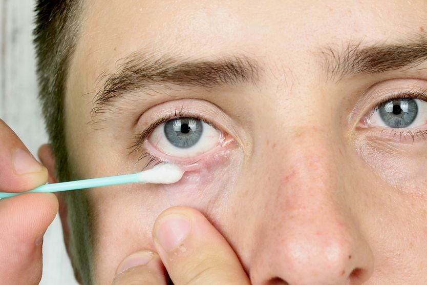 many applying ointment to eye with cotton swab