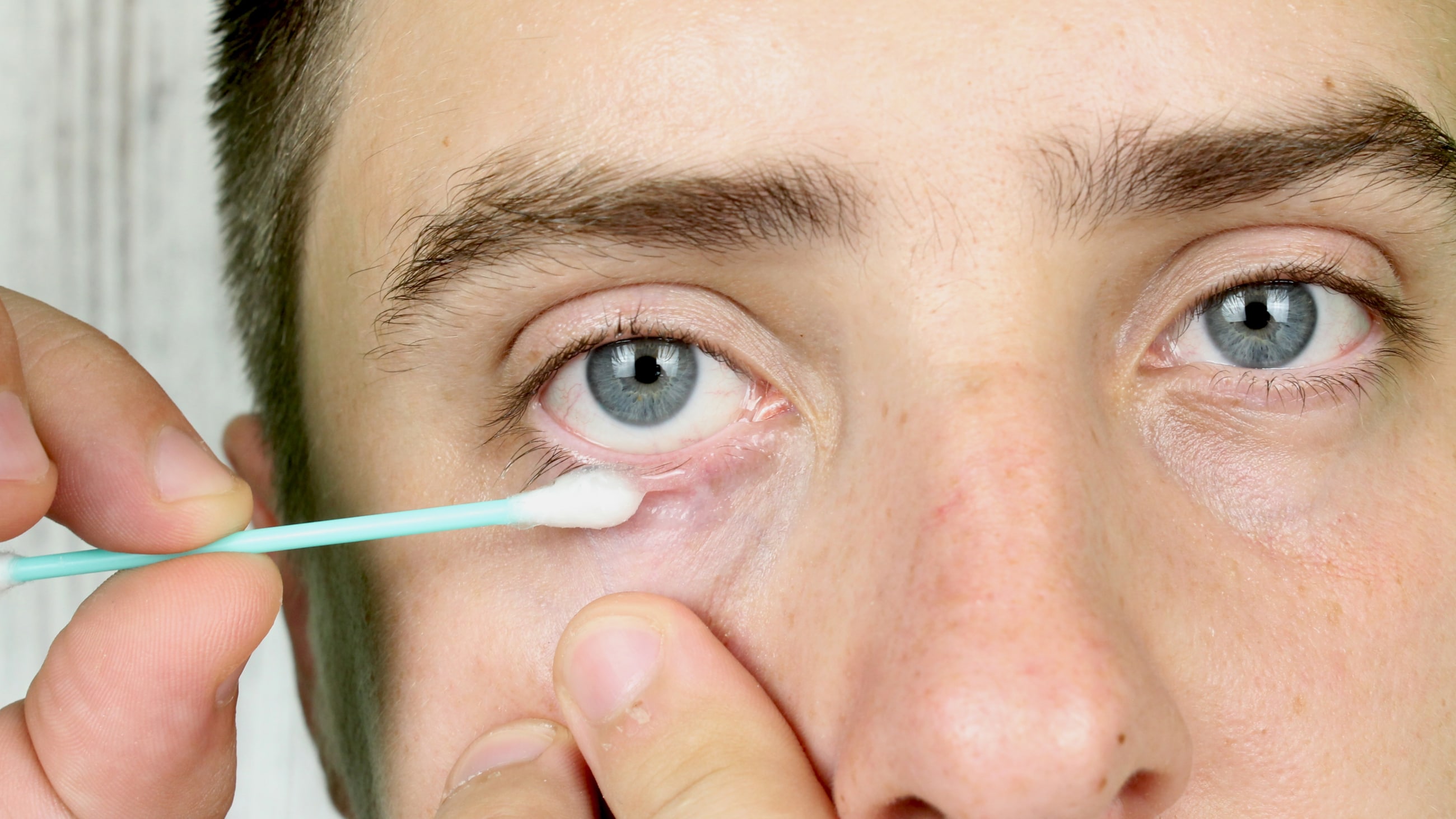 10 home remedies for styes 10 home remedies for styes