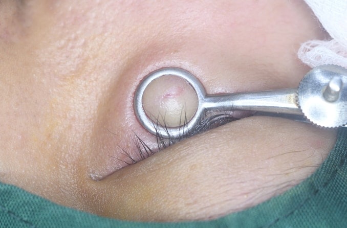 Stye removal: Surgery and other treatment methods Stye removal: Surgery and other treatment methods