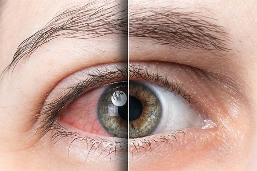 Red, sunburned eye versus healthy eye. Red, sunburned eye versus healthy eye.