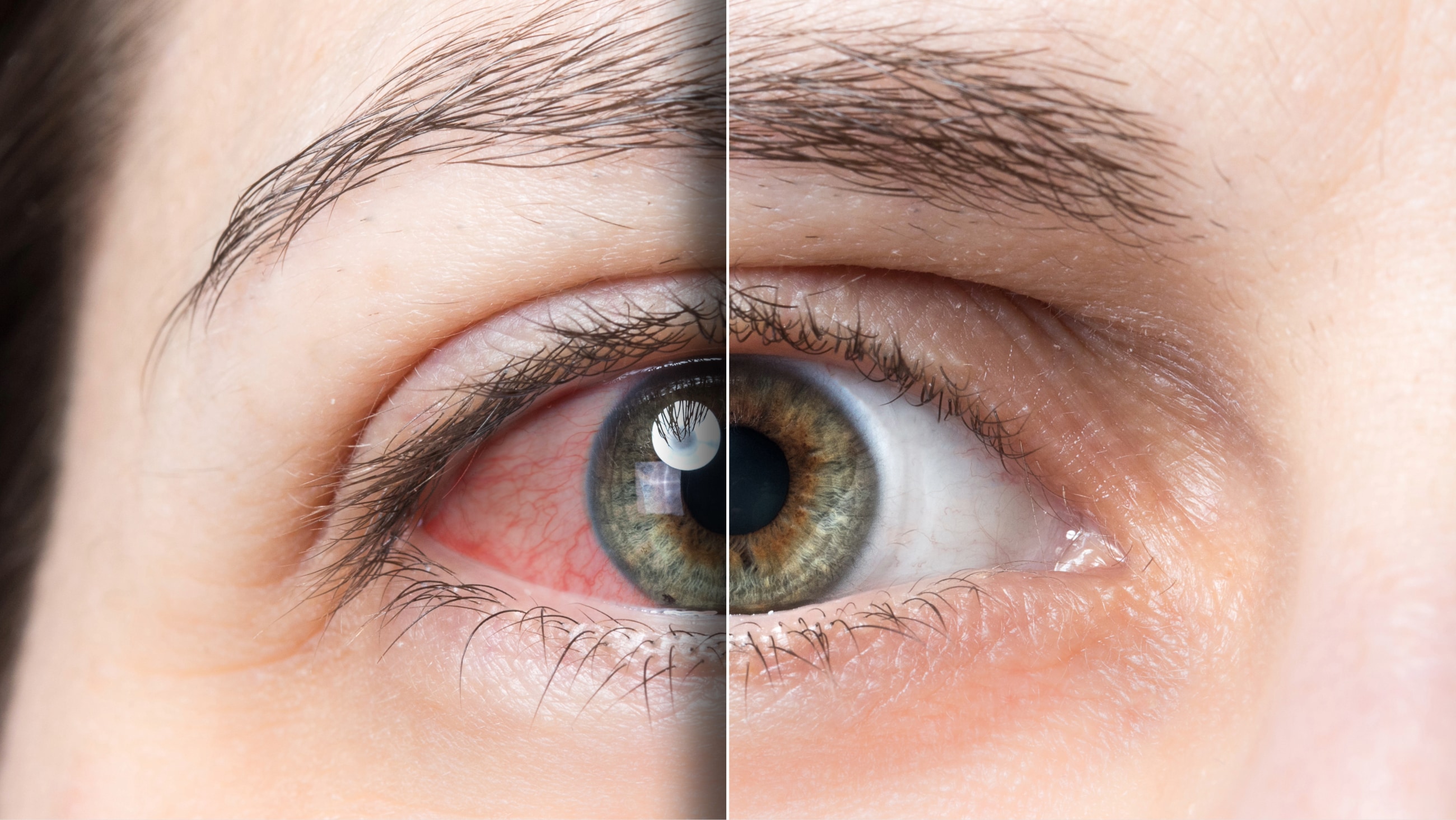 Understanding sunburned eyes (photokeratitis) Understanding sunburned eyes (photokeratitis)