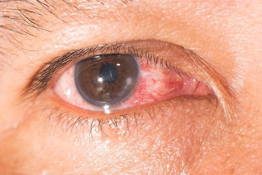 closeup of an eye with keratitis closeup of an eye with keratitis