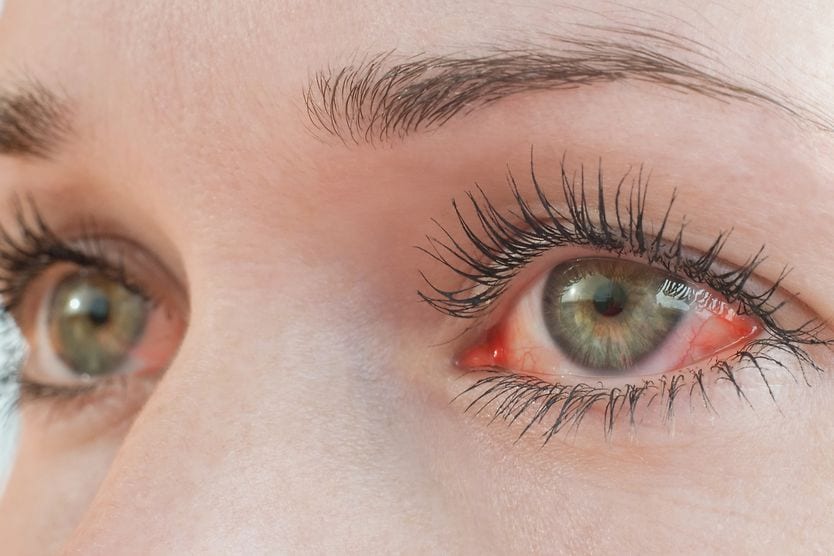 Eyes with symptoms of photokeratitis
