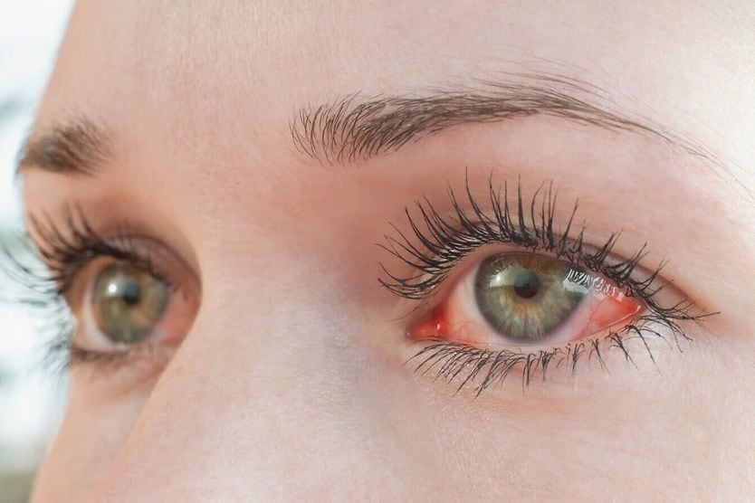 Eyes with symptoms of photokeratitis Eyes with symptoms of photokeratitis