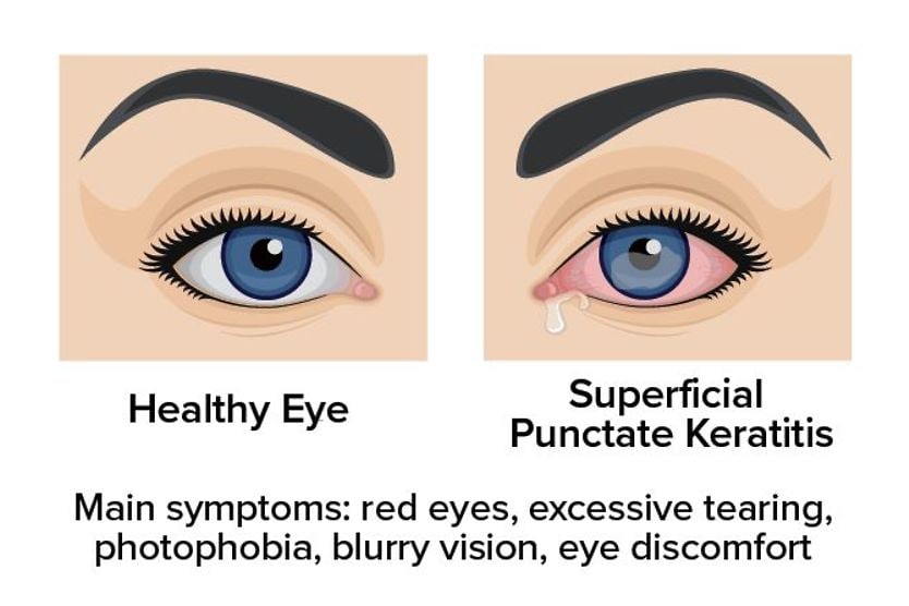 illustration showing the difference between a healthy eye and an eye with Superficial Punctate Keratitis illustration showing the difference between a healthy eye and an eye with Superficial Punctate Keratitis