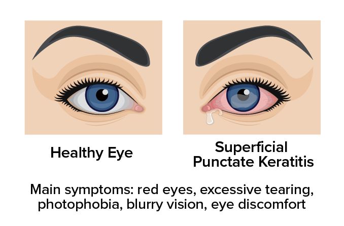 Superficial punctate keratitis: Symptoms, causes and treatment