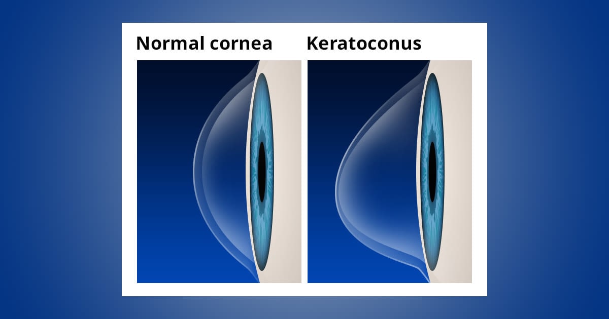 Keratoconus: Causes, symptoms and 10 treatment options