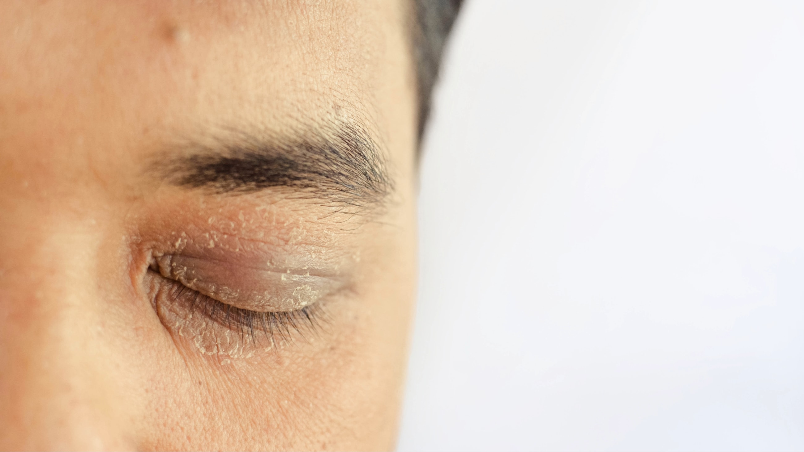 Dry eyelids: Symptoms, causes and treatments