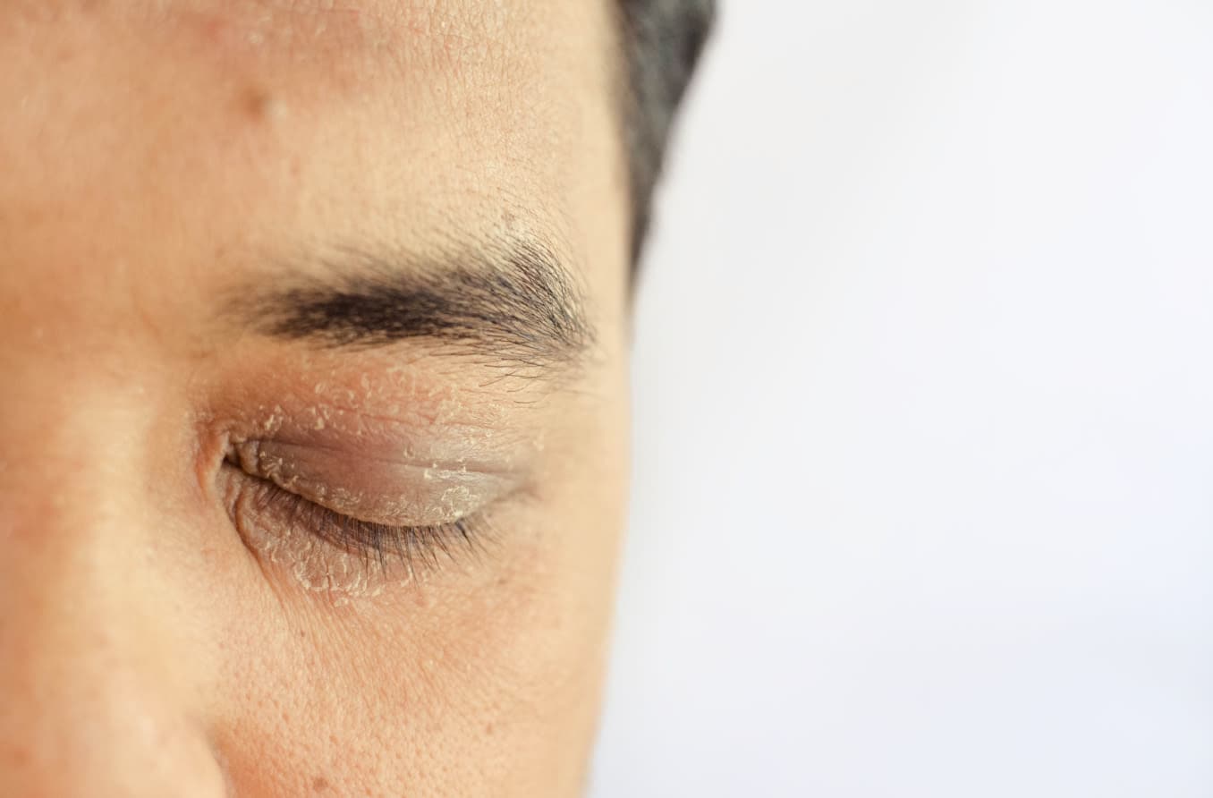 closeup of eyelids with dry skin