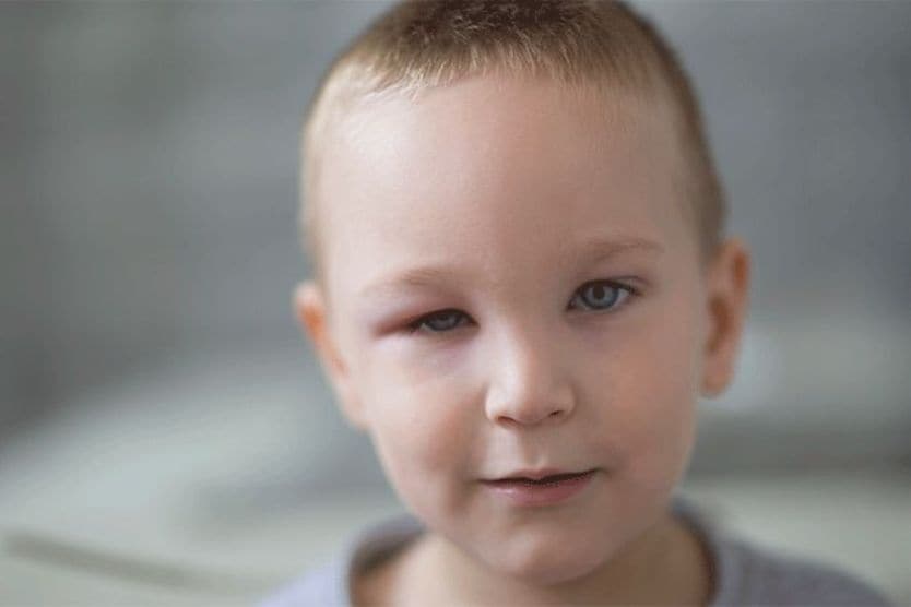 young boy with a swollen eyelid