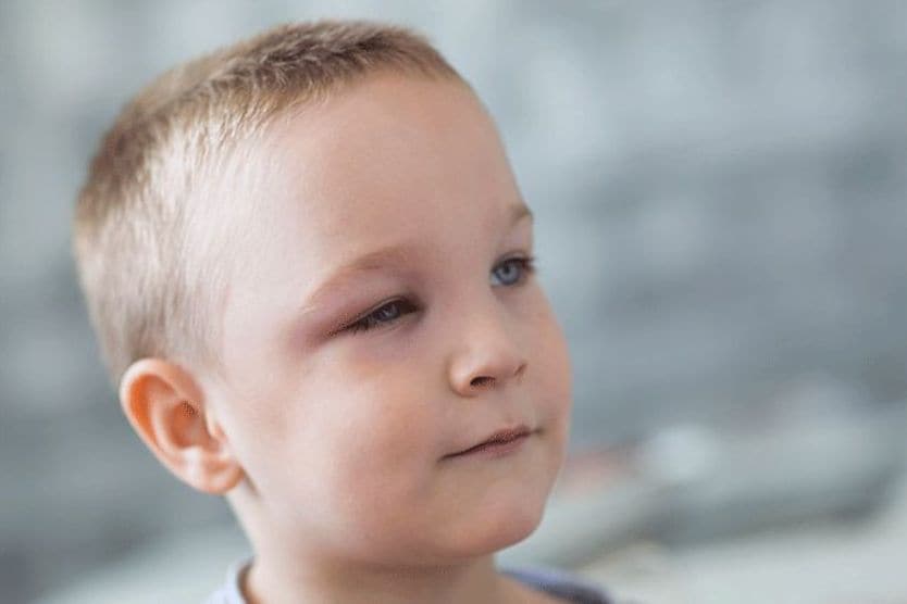 young boy with periorbital edema on one eye