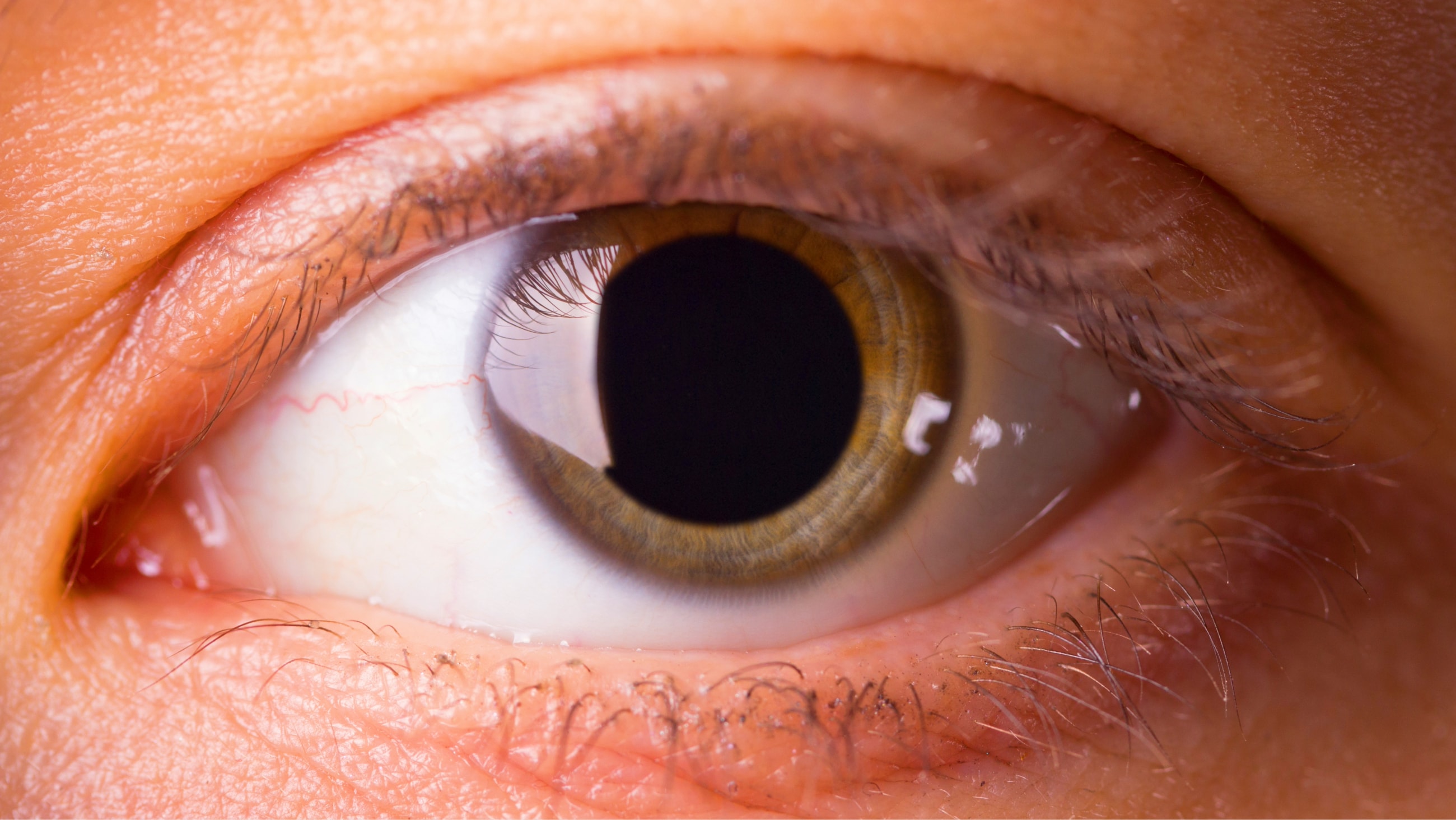 What is a blown pupil? What is a blown pupil?