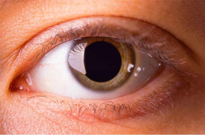 What is a blown pupil?