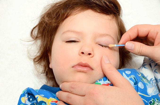 Goopy eyes: Causes and treatment