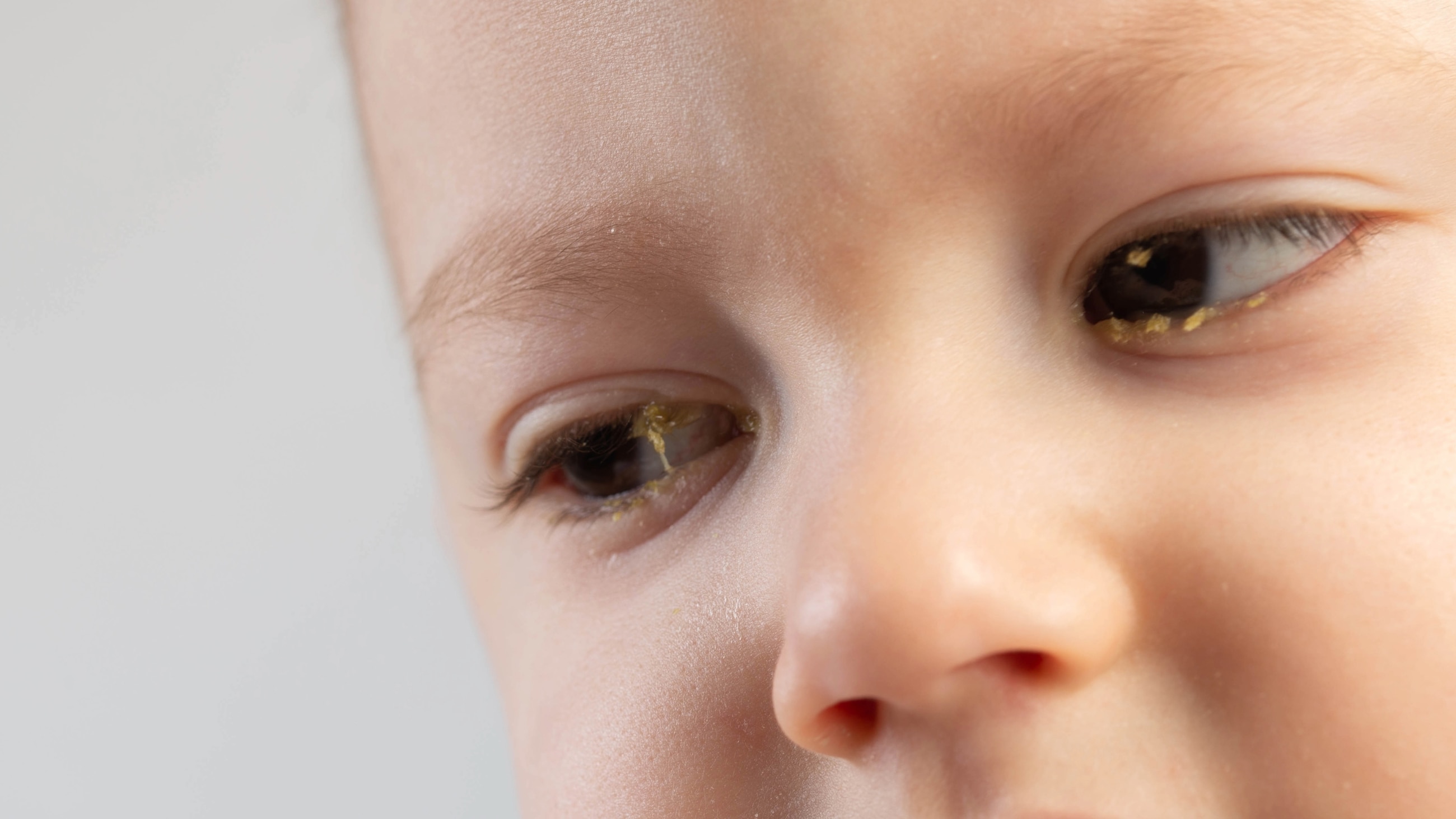 Sticky Eyes: Causes and Treatment Sticky Eyes: Causes and Treatment