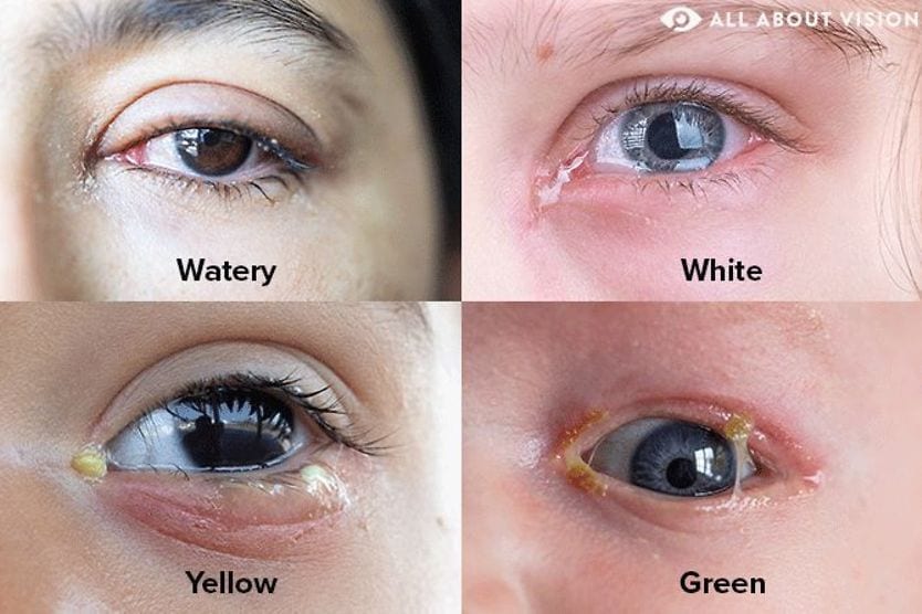closeups of the different types of eye discharge: watery, white discharge, yellow discharge and green discharge