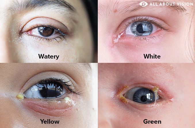 Eye discharge: White vs. yellow vs. green