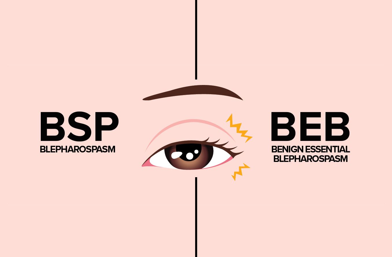 Blepharospasm: Symptoms, causes and treatment