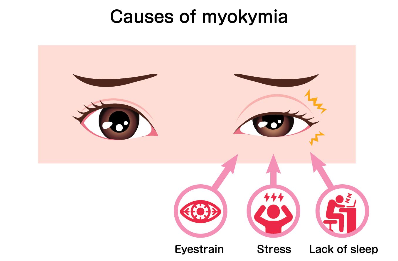 Myokymia: Eyelid twitch or tic