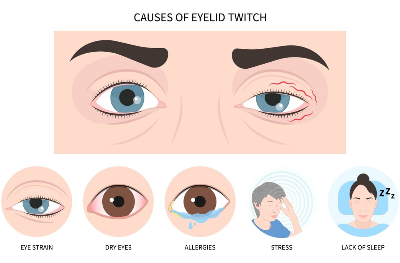 Eye drops and other treatments for eye twitching