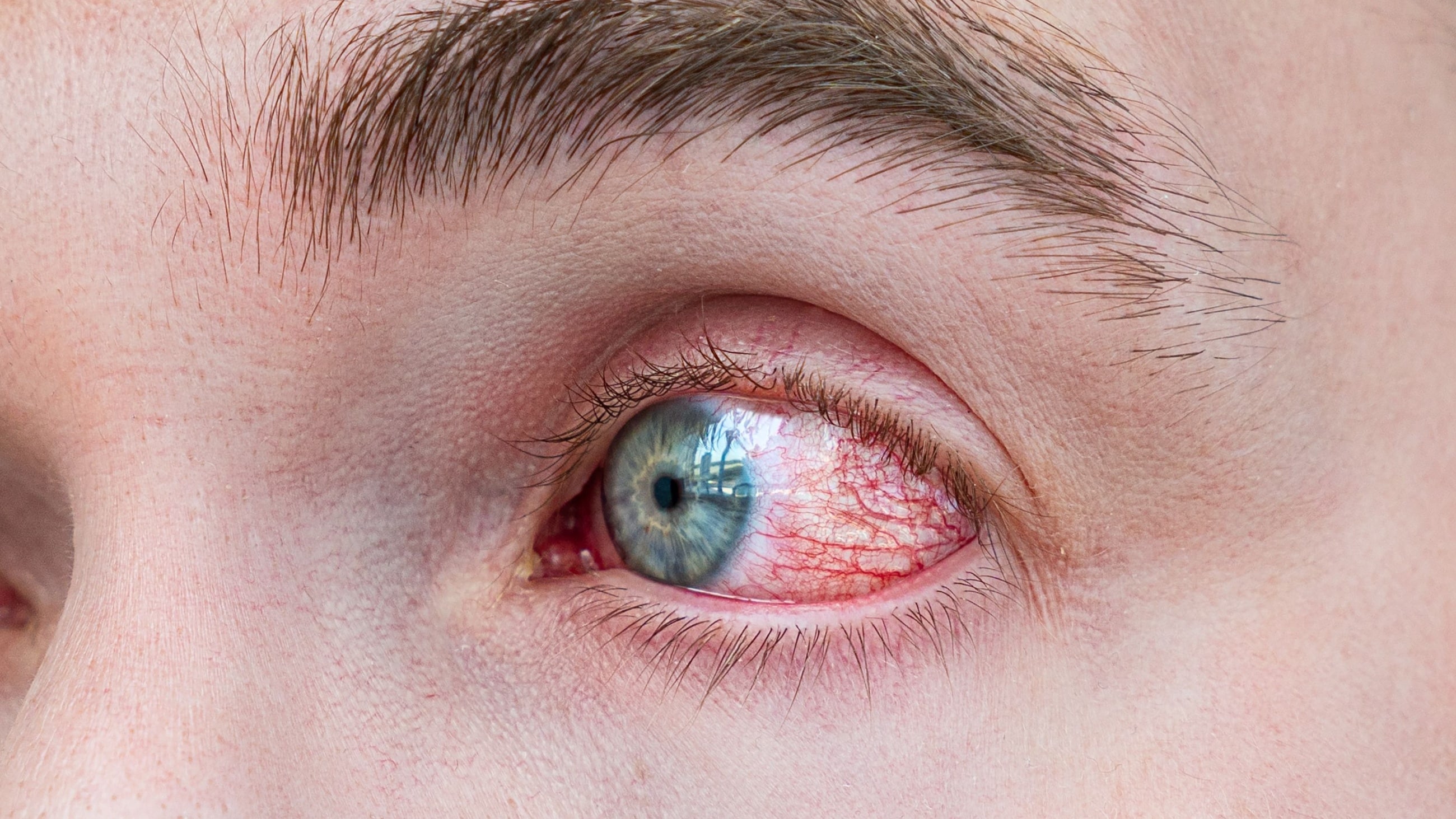 illustration of red eyes (inflamed and irritated sclera)