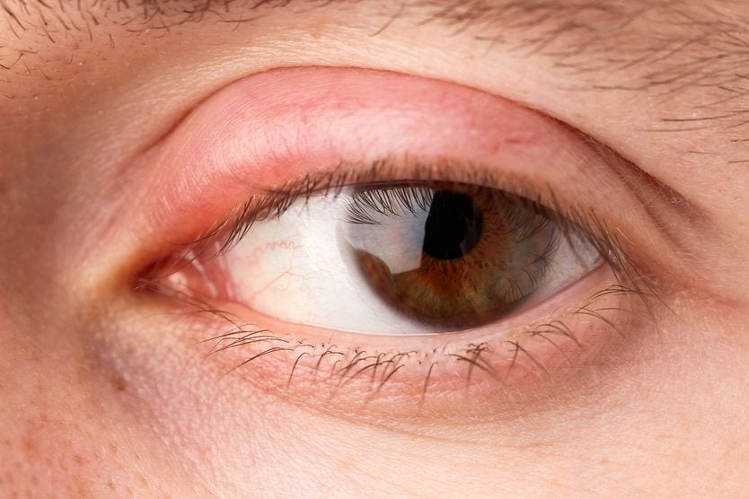 man with a swollen eyelid man with a swollen eyelid