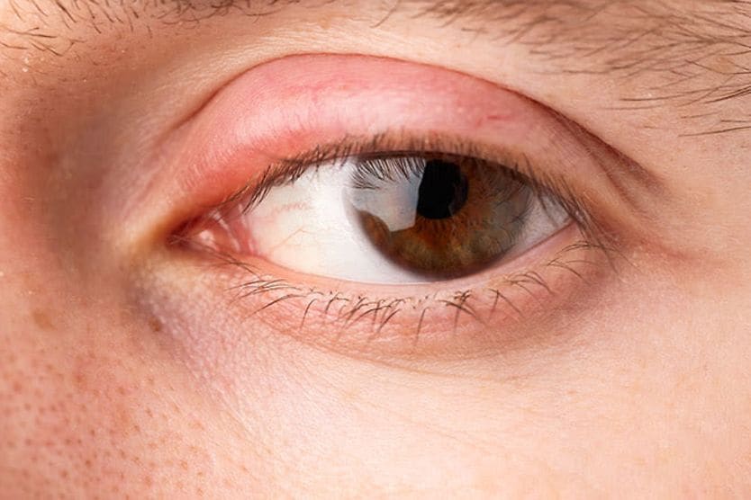 man with a swollen eyelid
