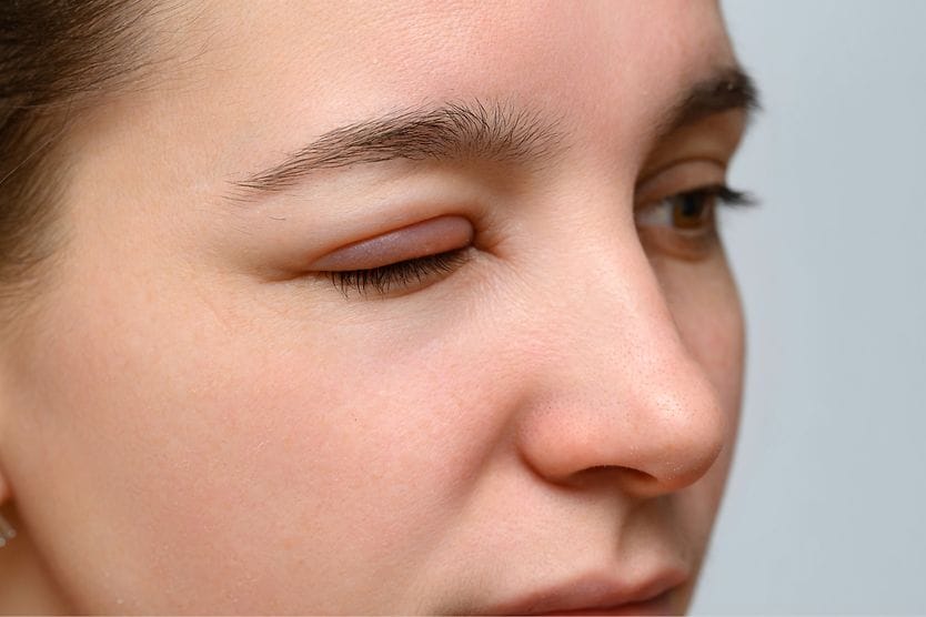 Swollen eyelid