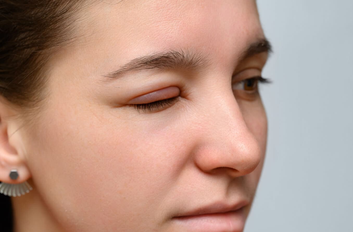 What causes swollen eyelids?