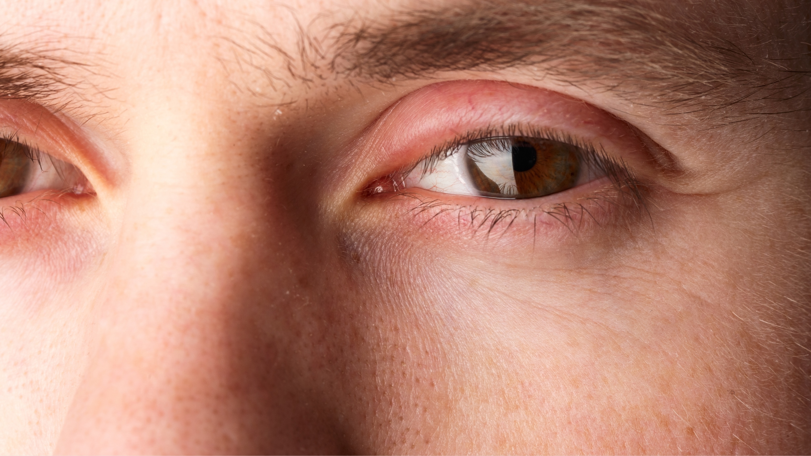 Swollen eyelid treatment and prevention Swollen eyelid treatment and prevention