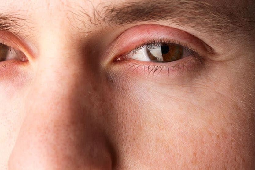 man with a swollen eyelid