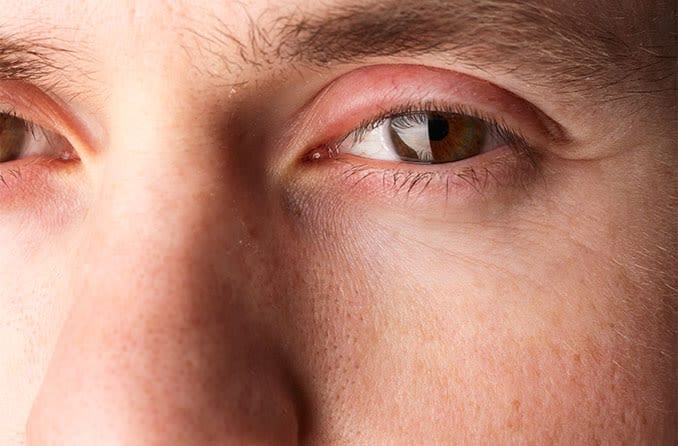 Swollen eyelid treatment and prevention