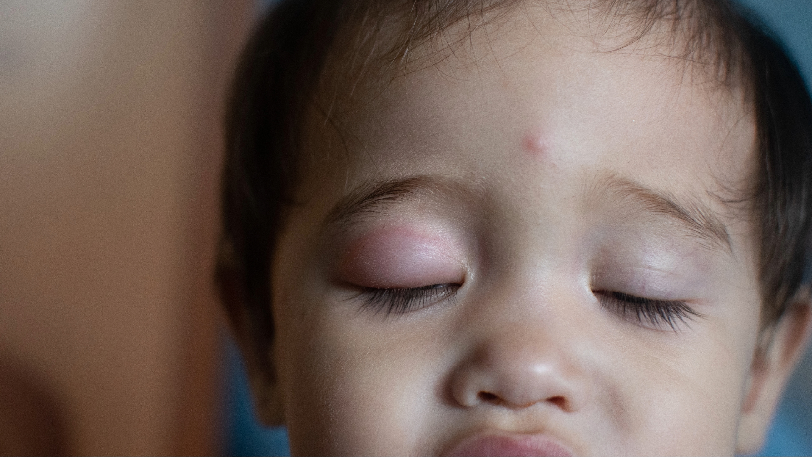 Treating swollen eyes in toddlers and children