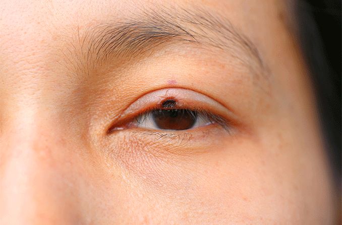 Eyelid cancer: Types, symptoms and treatments