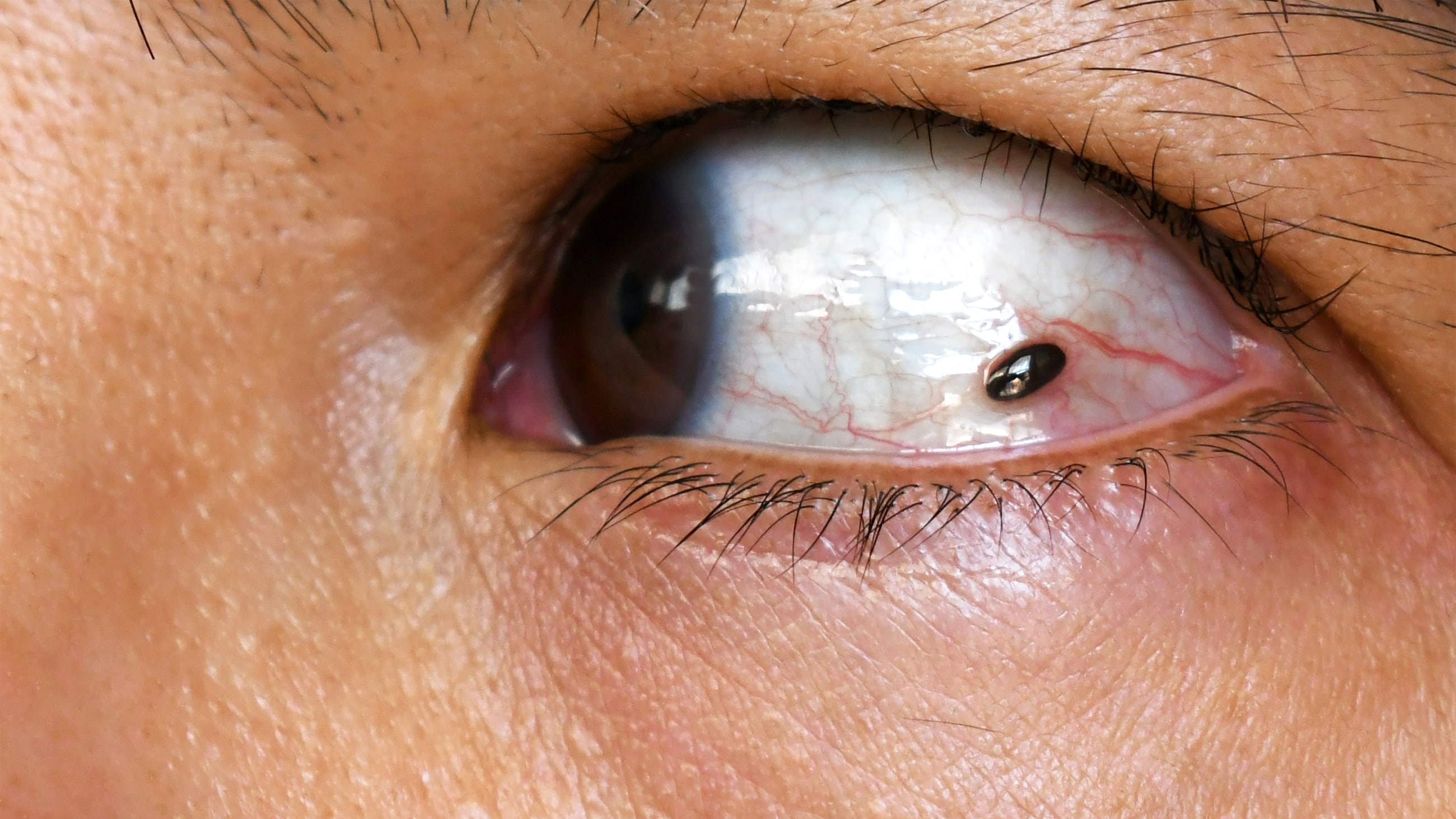 Ocular melanoma Ocular melanoma